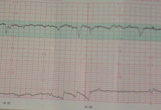 什么叫胎心监护 胎心监护的作用是什么