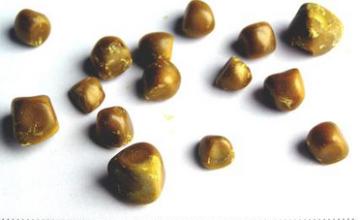 肾结石是什么？肾结石怎么治最好