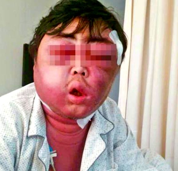 俊美的脸被打肿了怎么办你知道吗