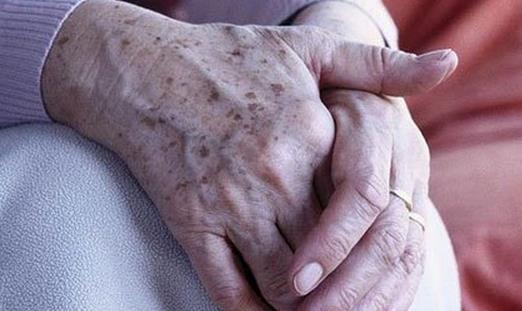 得了老年斑不可怕，老年斑有消除办法