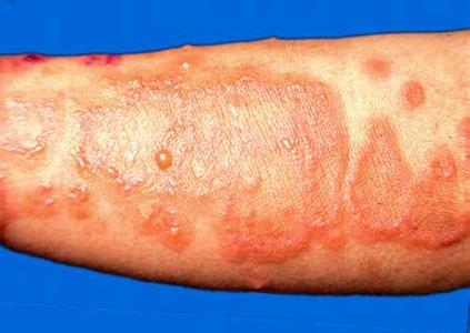 各种皮肤病治疗的小偏方 让你快速康复