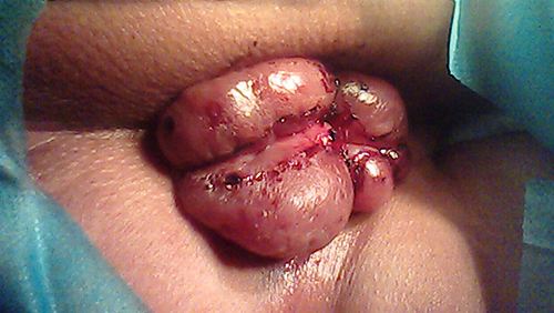 十男九痔之外痔疮