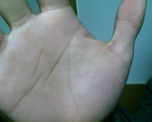 手脱皮怎么办，三招立马解决