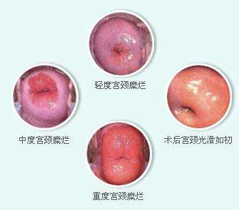 造成轻度宫颈糜烂的主要原因以及它的症状是什么