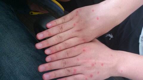 挠挠挠皮肤瘙痒起红疙瘩怎么办