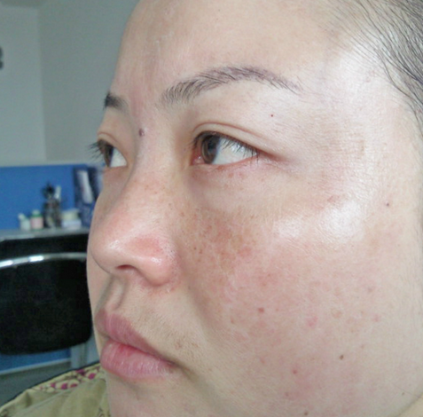 蝴蝶斑是怎么形成的  两大因素