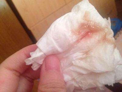 白带异常怎么办及正常白带是什么样的介绍