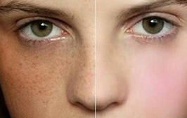 蝴蝶斑是怎么形成的  两大因素