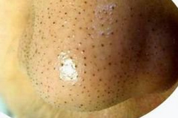 鼻子上有黑头怎么办  教你几招