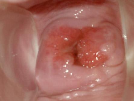 女人病的危害 宫颈糜烂有什么症状