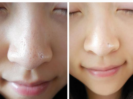 鼻子上有黑头怎么办  教你几招