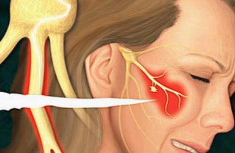 大脑路线  三叉神经痛症状
