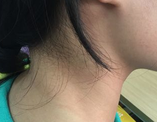 折磨人的咽喉炎，咽喉炎症状有哪些