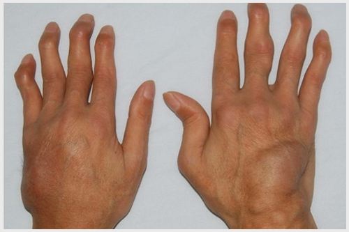 类风湿关节炎偏方 让你更快恢复