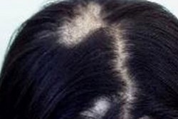 头癣的症状和局部治疗方法