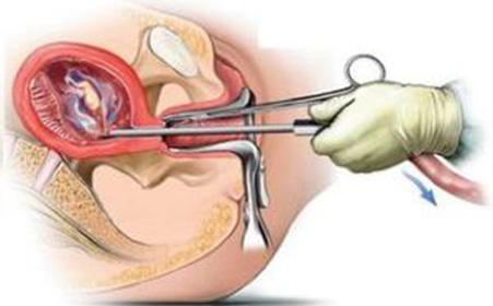 来的不是时候 人流最佳时间