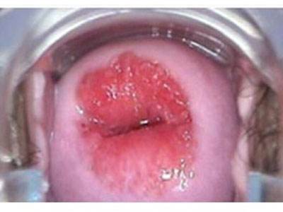 妇科炎症宫颈肥大是怎么回事