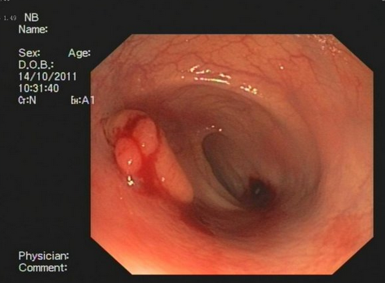 肠镜检查 六种方法你懂吗