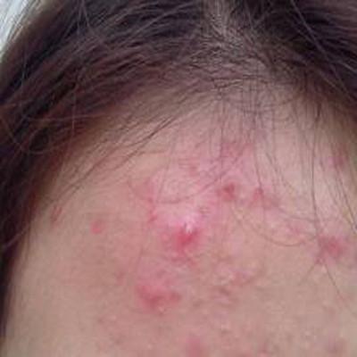 额头长痘痘怎么调理 教你几招祛痘方法