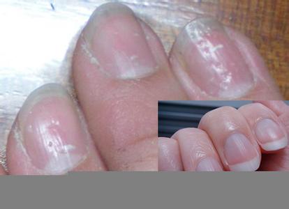 亚健康的表现 手指甲上有小坑