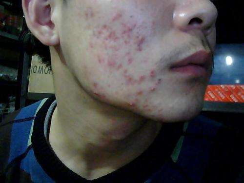 快速简单的祛痘方法 脸上长痘痘怎么快速去除