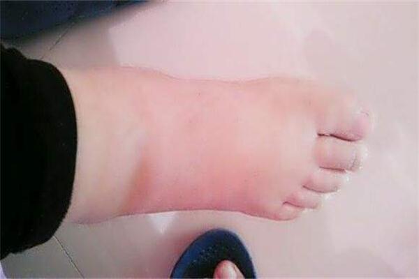 脚肿了怎么办 脚肿的原因