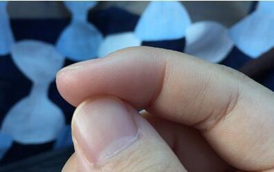 肝脏不好的症状 指甲症状尤为明显