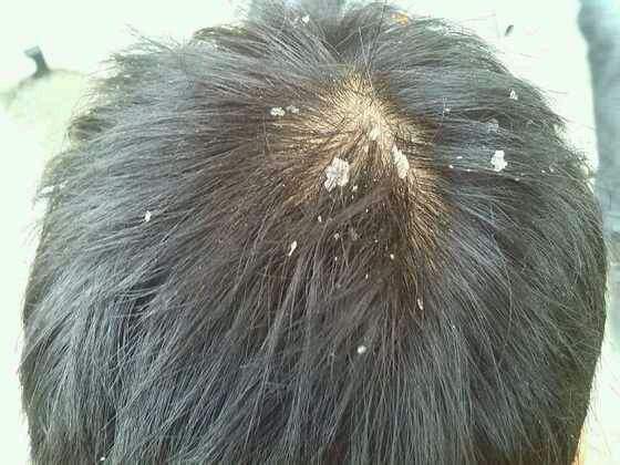 头屑多是什么原因 中医6偏方帮你去头屑