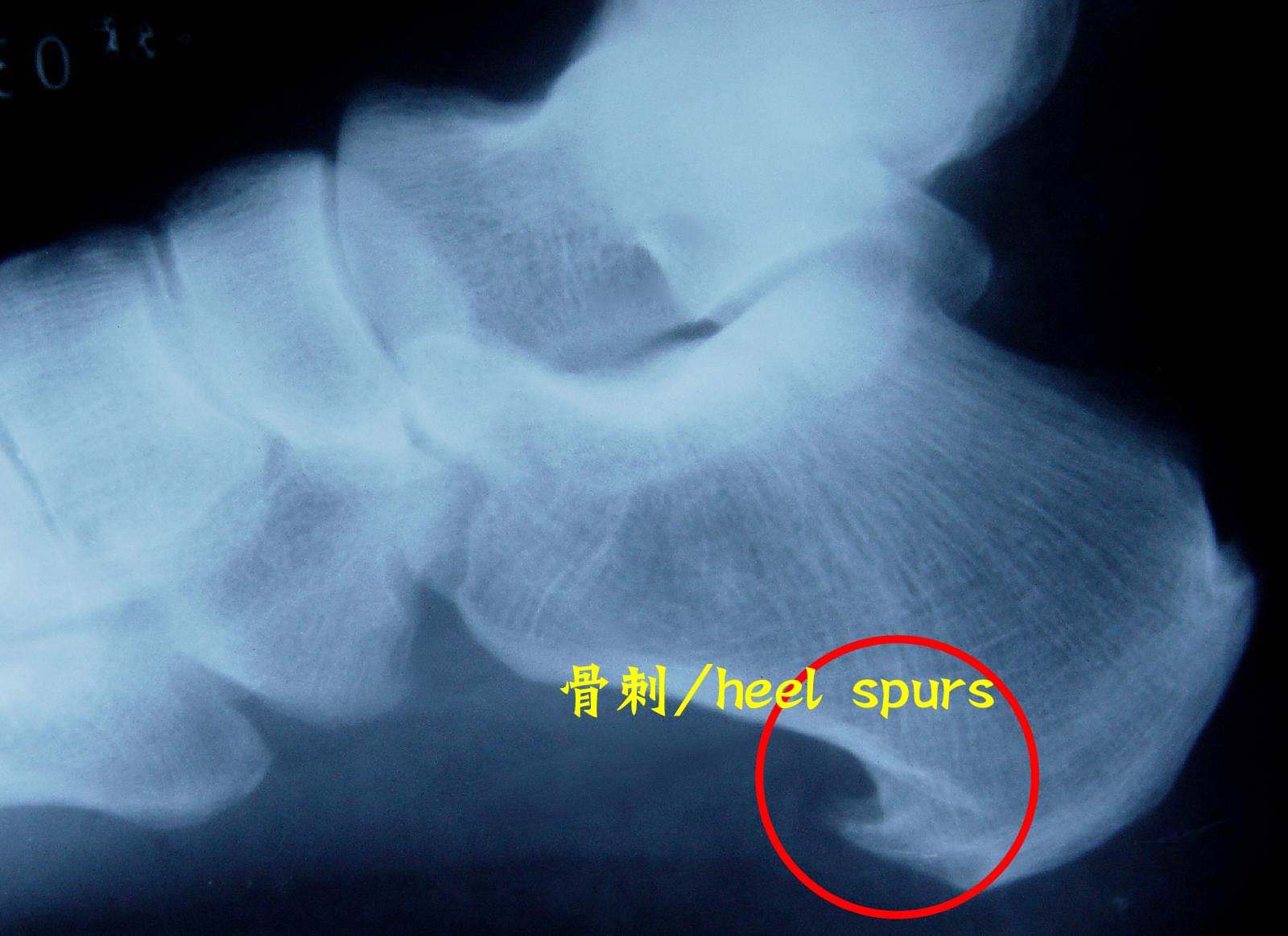 骨刺到底是不是病，治疗骨刺的偏方