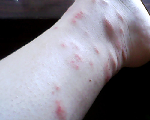 皮肤过敏了怎么办？这可不是小事