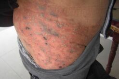 带状疱疹怎么治疗 西药治疗带状疱疹的方法