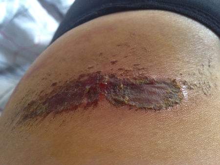 伤口发炎怎么办 帮助伤口愈合的食物