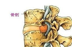 骨刺到底是不是病，治疗骨刺的偏方