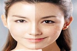 讨厌的黄褐斑，中医祛黄褐斑