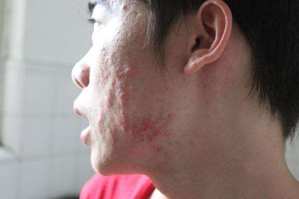 痤疮怎样治 日常护理和药物治疗方法