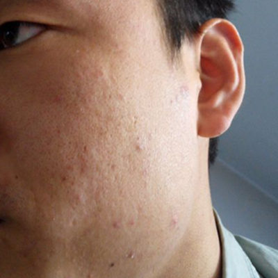 脸上有痘坑 最有效的5种方法