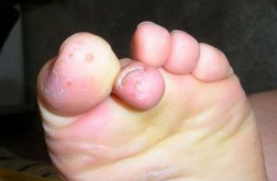 教你脚气脚臭7种治理方法