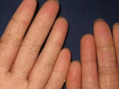 手足癣日常护理措施和治疗工作大全