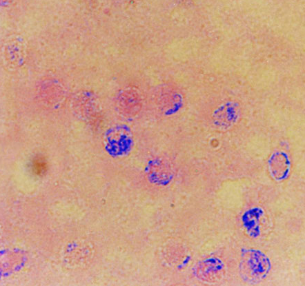 丹毒的症状  一般出现在小腿、脸部