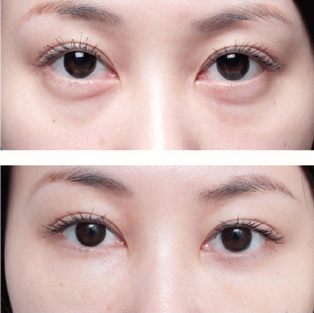 很多年轻人纠结怎么去除眼袋