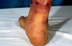 丹毒的症状  一般出现在小腿、脸部