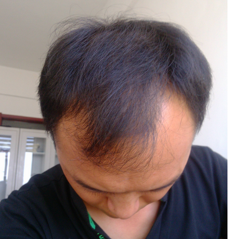 很多人都想知道怎样治疗脱发