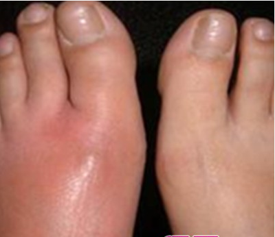 丹毒的症状  一般出现在小腿、脸部