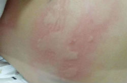 荨麻疹的症状 主要有以下六种