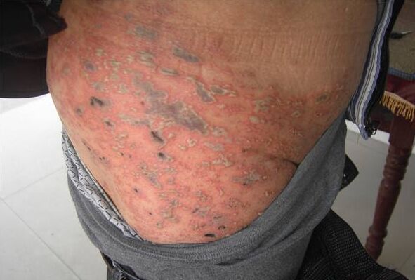 带状疱疹怎么治疗 西药治疗带状疱疹的方法