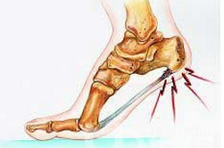 跟骨骨膜炎患者如何治疗更有效