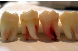 智齿发炎 注重口腔卫生问题