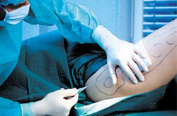 抽脂的危害  五种危害你知道吗