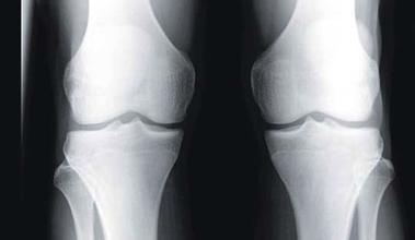 骨刺到底是不是病，治疗骨刺的偏方