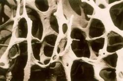 青少年骨质疏松吃什么能更快康复